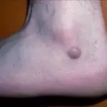 Дерматофиброма на ноге